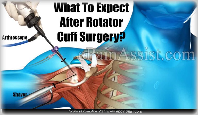 What To Expect After Rotator Cuff Surgery? (Recovery Period)