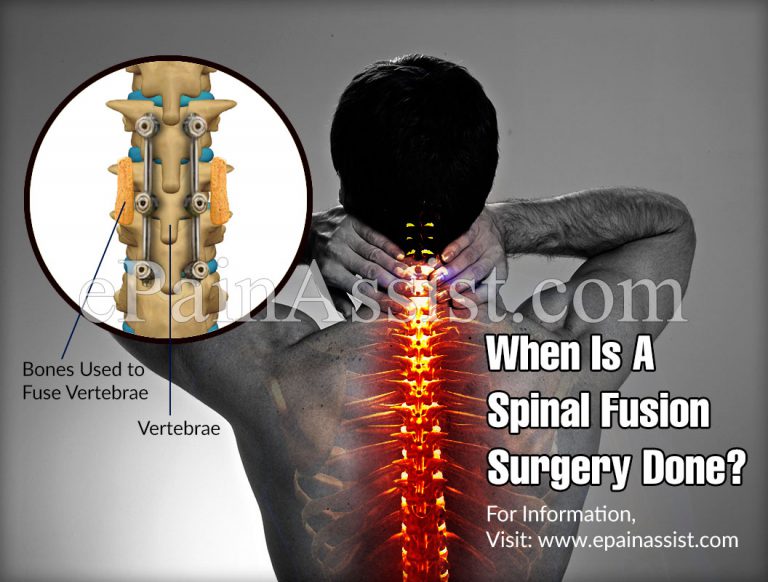 When is Spinal Fusion Surgery Done, Know its Risks, Recovery Period