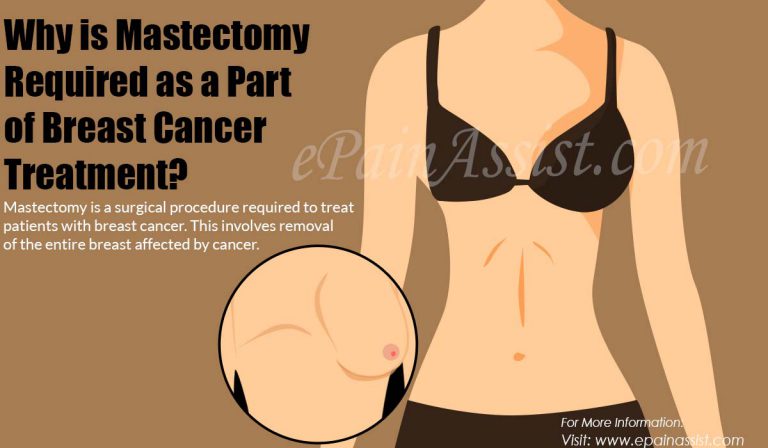 Why is Mastectomy Required as a Part of Breast Cancer Treatment & Is Chemotherapy Necessary After A Mastectomy?