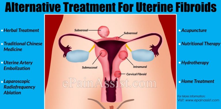 Alternative Treatment For Uterine Fibroids