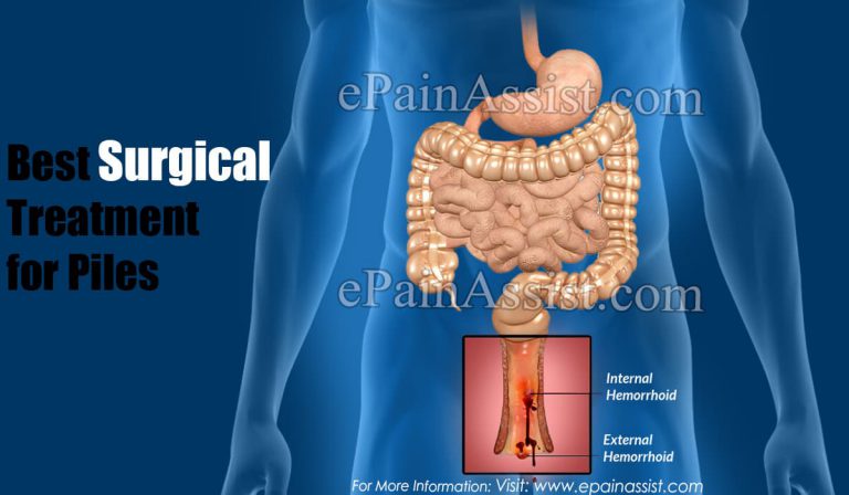 Best Surgical Treatment for Piles