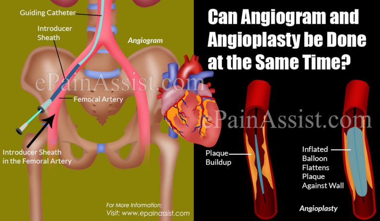 Can Angiogram and Angioplasty be Done at the Same Time?