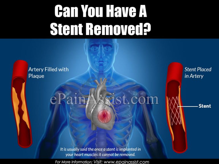 Can You Have a Stent Removed?