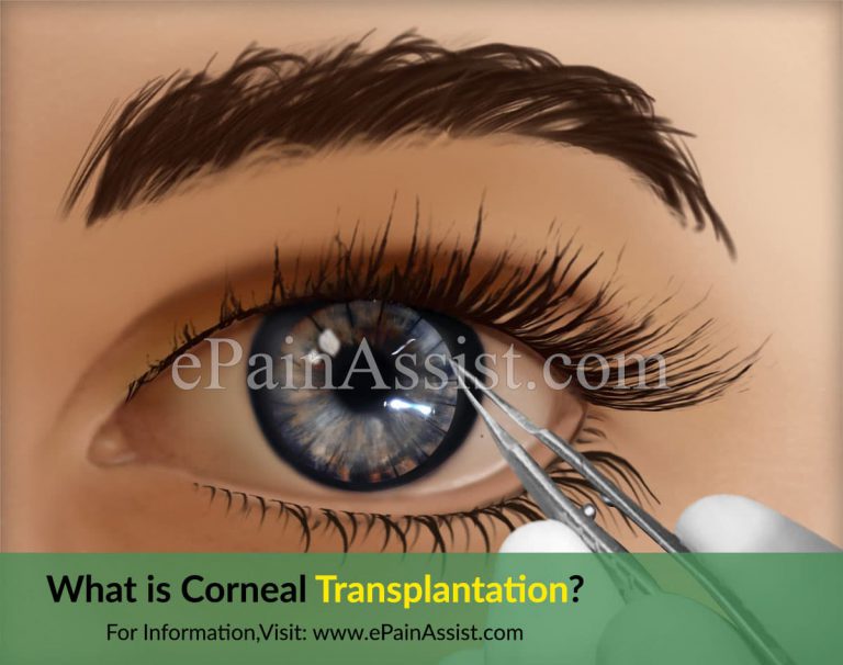 Corneal Transplant: Why is it Needed, Types, Risks Factors, What to Expect After Corneal Transplant, Success Rate