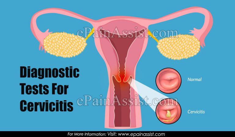 Diagnostic Tests For Cervicitis