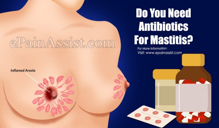 Do You Need Antibiotics For Mastitis?
