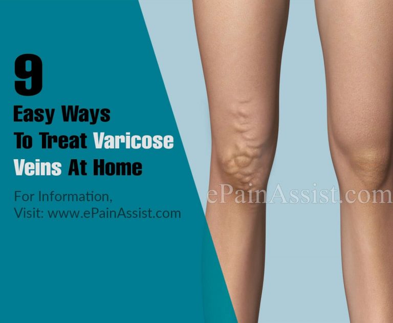 9 Easy Ways To Treat Varicose Veins At Home