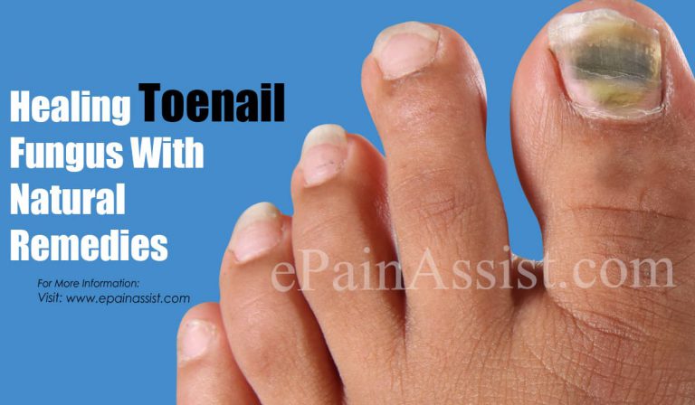 Healing Toenail Fungus With Natural Remedies
