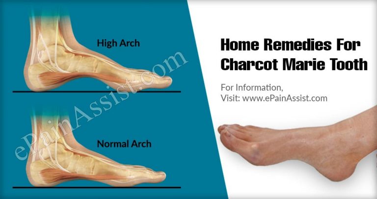 Home Remedies For Charcot Marie Tooth