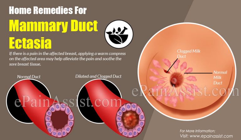 Home Remedies For Mammary Duct Ectasia