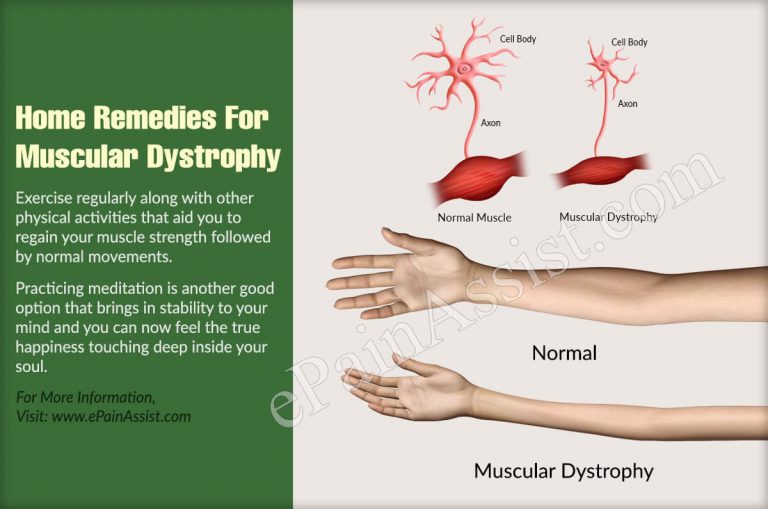 Home Remedies For Muscular Dystrophy