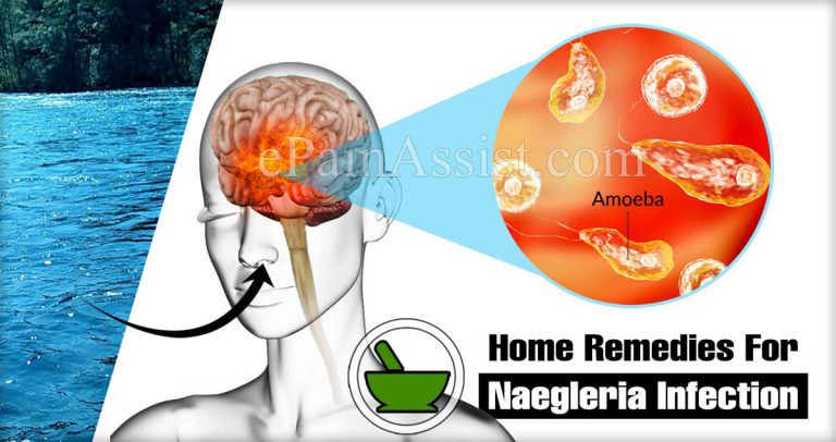 Home Remedies For Naegleria Infection