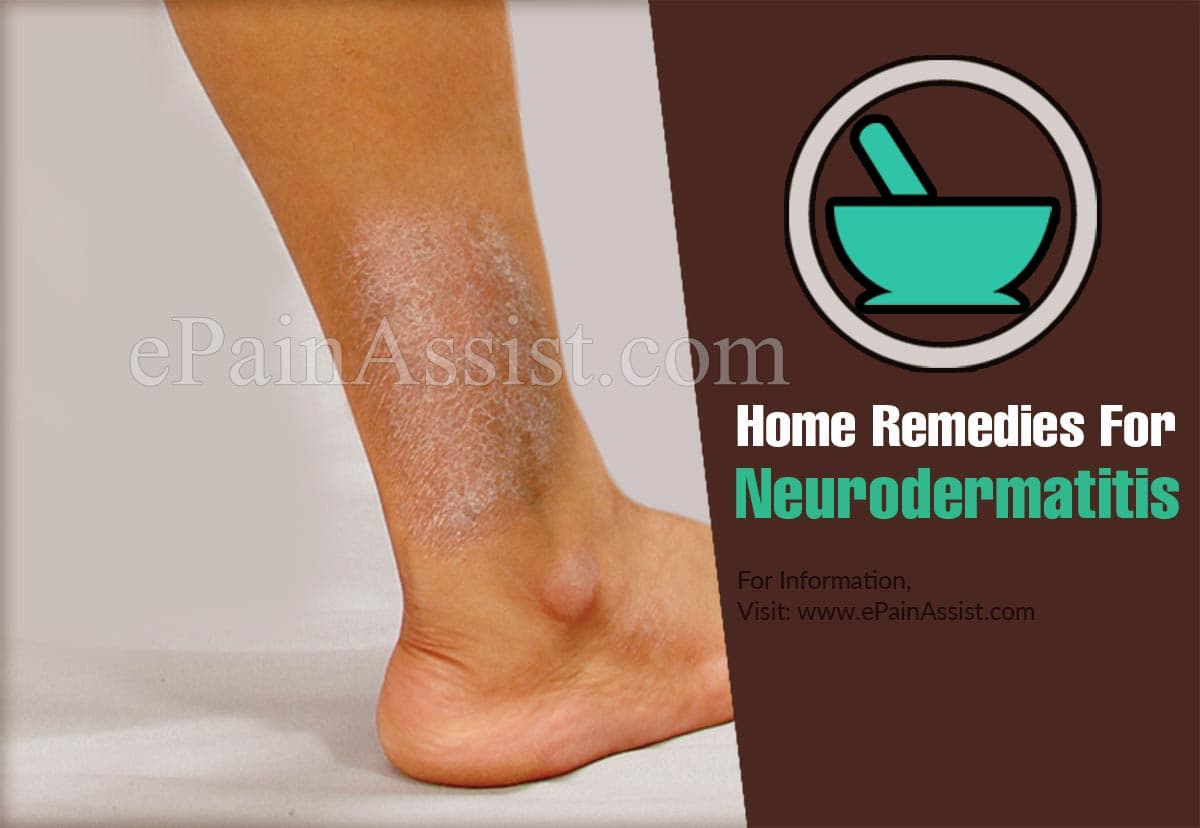 Home Remedies For Neurodermatitis