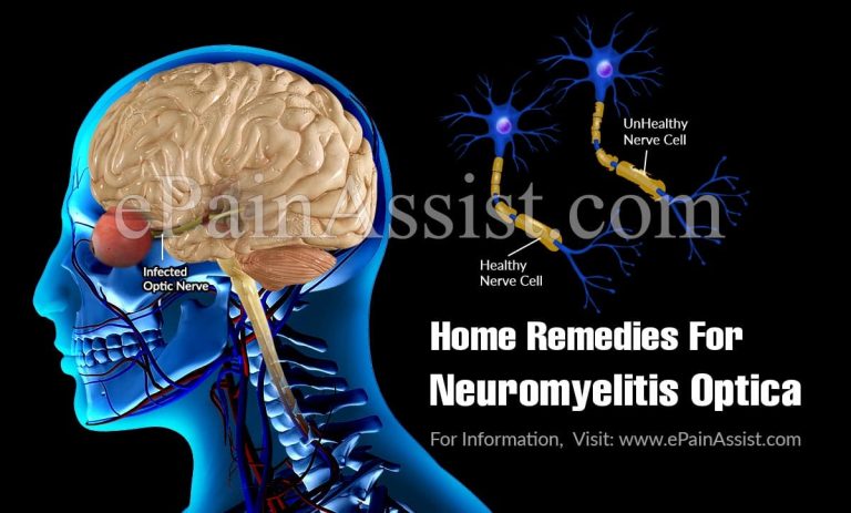 Home Remedies For Neuromyelitis Optica