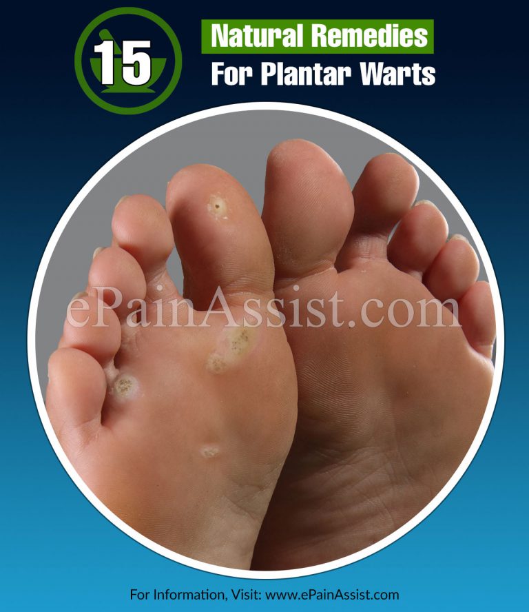 15 Home Remedies For Plantar Warts & Its Preventive Measures