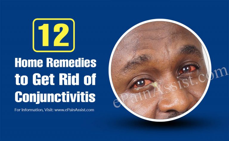 12 Home Remedies to Get Rid of Conjunctivitis