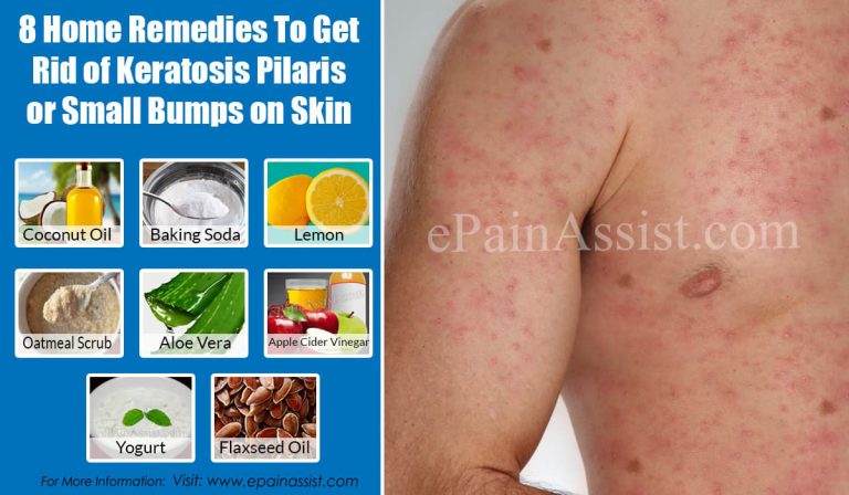 8 Home Remedies To Get Rid of Keratosis Pilaris or Small Bumps on Skin