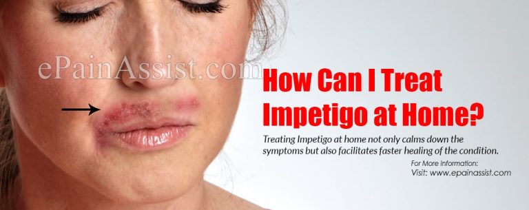 How Can I Treat Impetigo at Home?