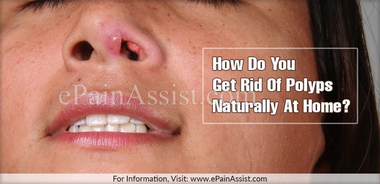 How Do You Get Rid Of Polyps Naturally At Home?
