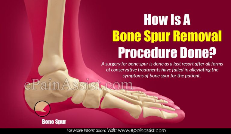 How Is A  Bone Spur Removal Procedure Done?