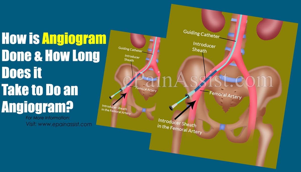 How is Angiogram Done & How Long Does it Take to Do an Angiogram?