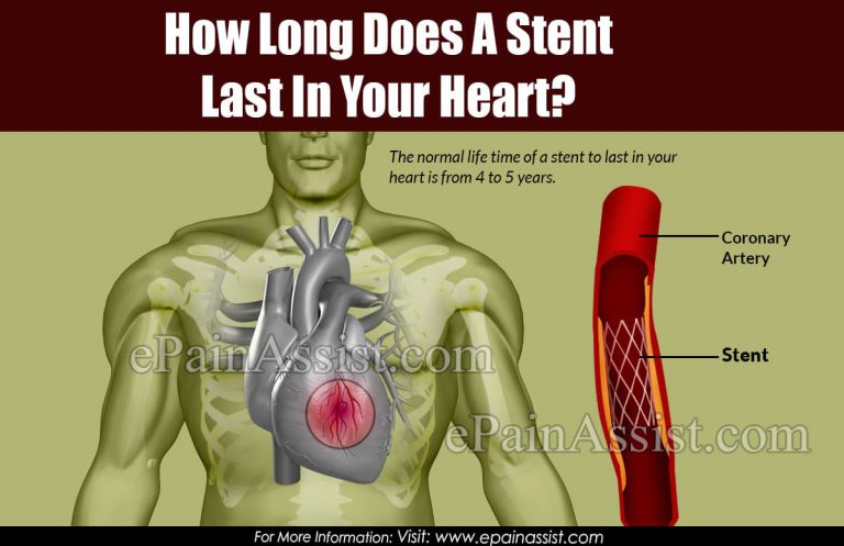 How Long Does A Stent Last In Your Heart?