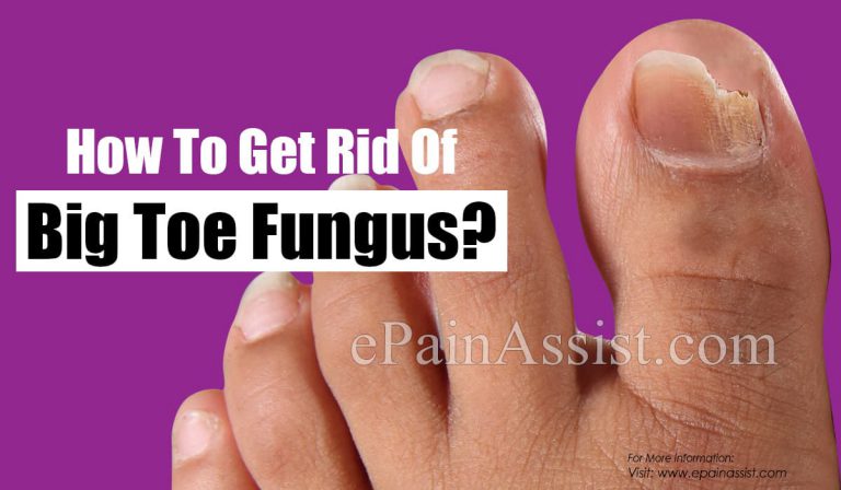 How To Get Rid Of Big Toe Fungus?