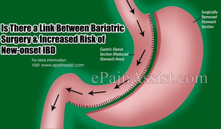 Is There a Link Between Bariatric Surgery & Increased Risk of New-onset IBD