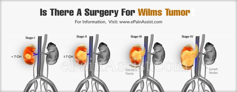 Is There A Surgery For Wilms Tumor?