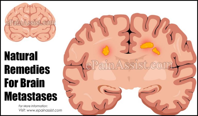 Natural Remedies For Brain Metastases