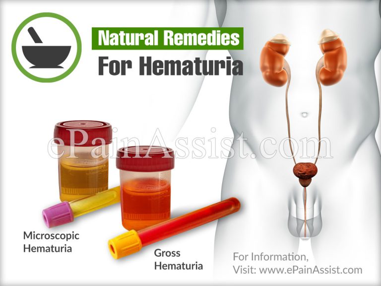 Natural Remedies For Hematuria