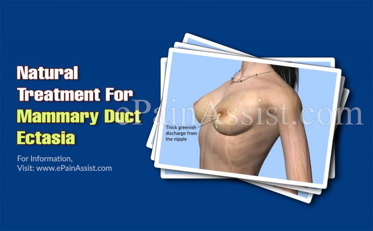 Natural Treatment For Mammary Duct Ectasia