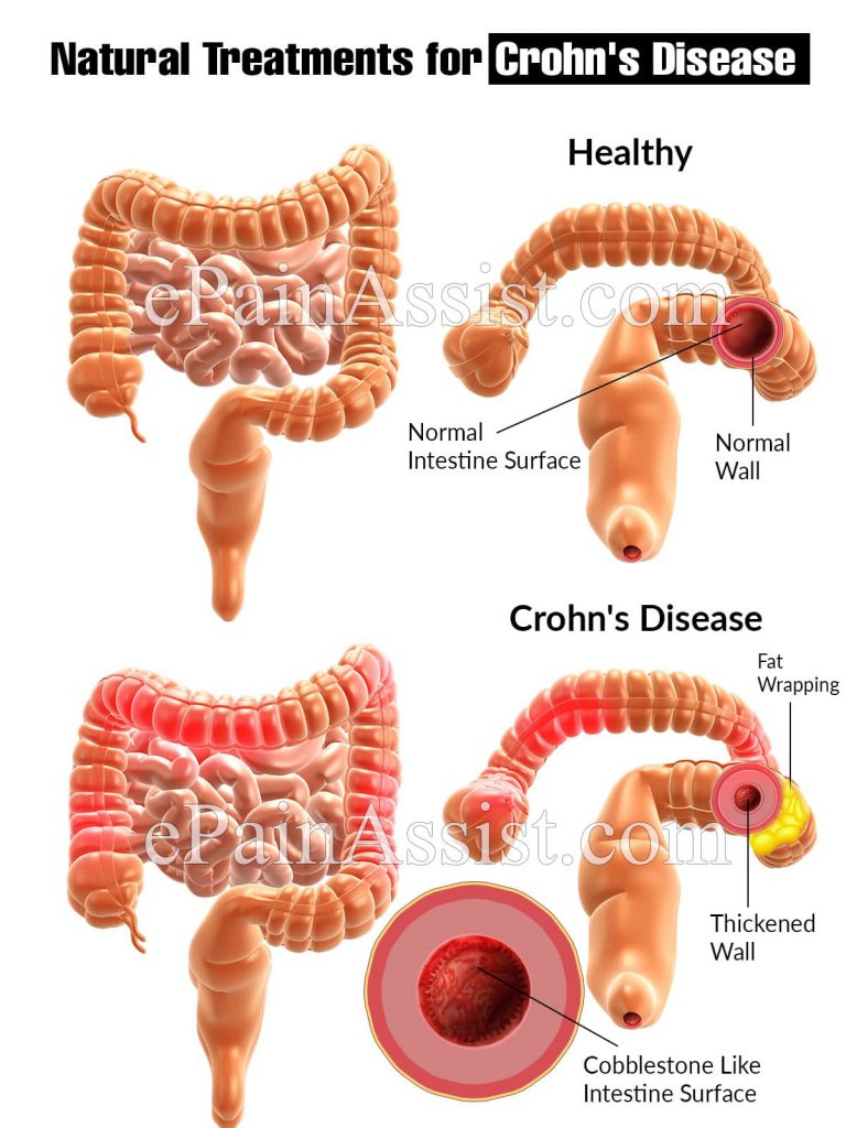 Natural Treatments for Crohn’s Disease
