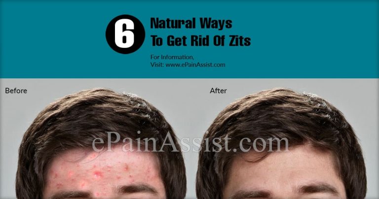 Natural Ways To Get Rid Of Zits