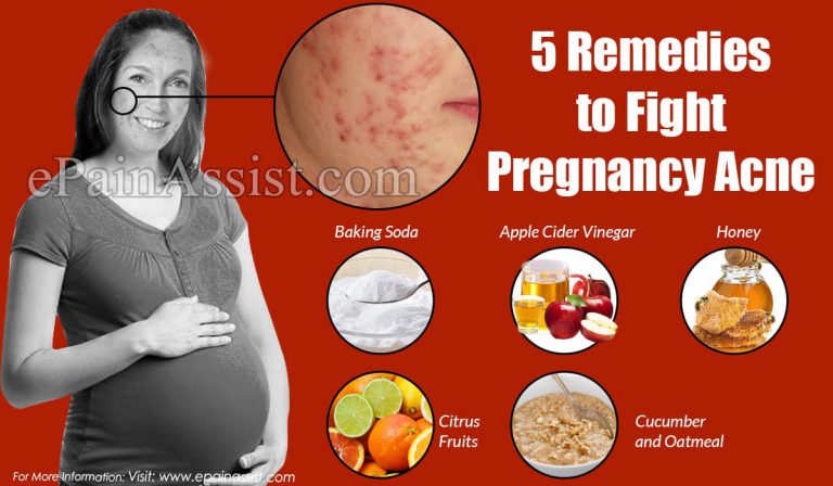 5 Remedies to Fight Pregnancy Acne