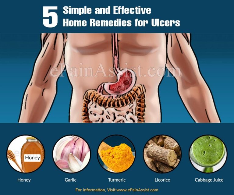5 Simple and Effective Home Remedies for Ulcers