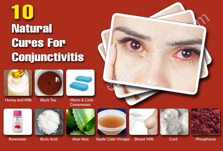 Top 10 Natural Cures For Conjunctivitis