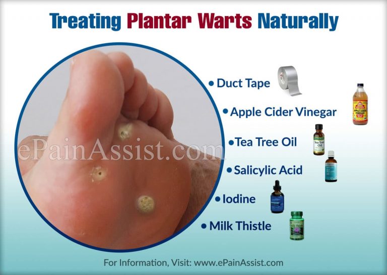 Treating Plantar Warts Naturally
