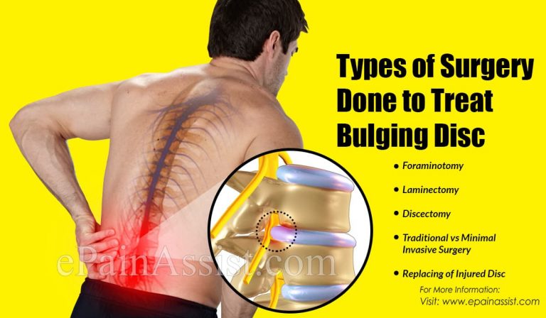 Types of Surgery Done to Treat Bulging Disc