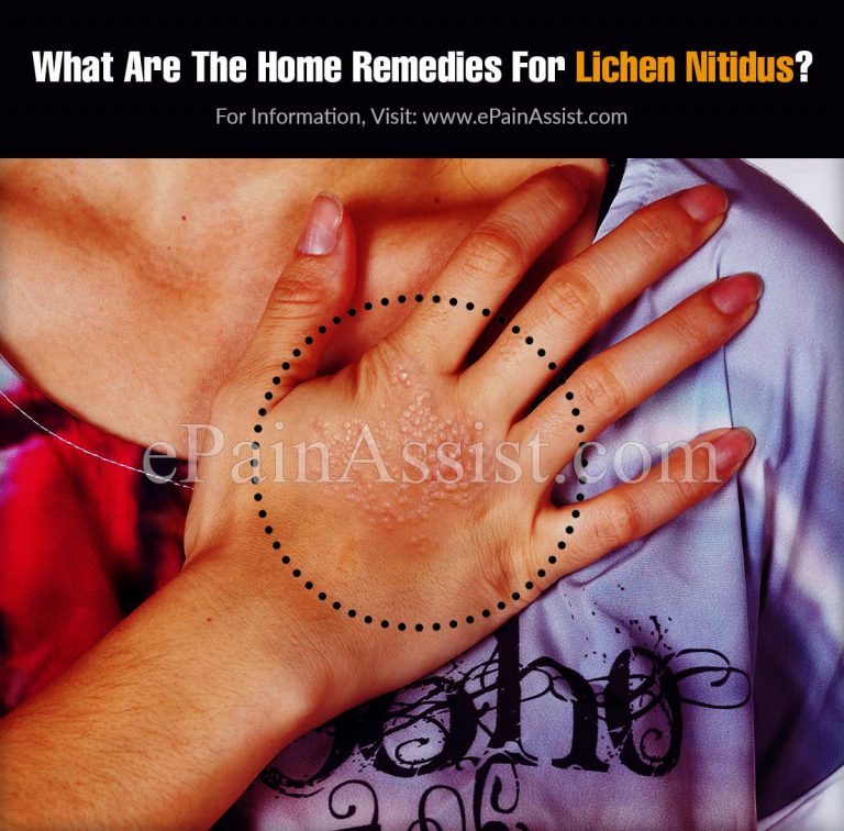 What Are The Home Remedies For Lichen Nitidus?