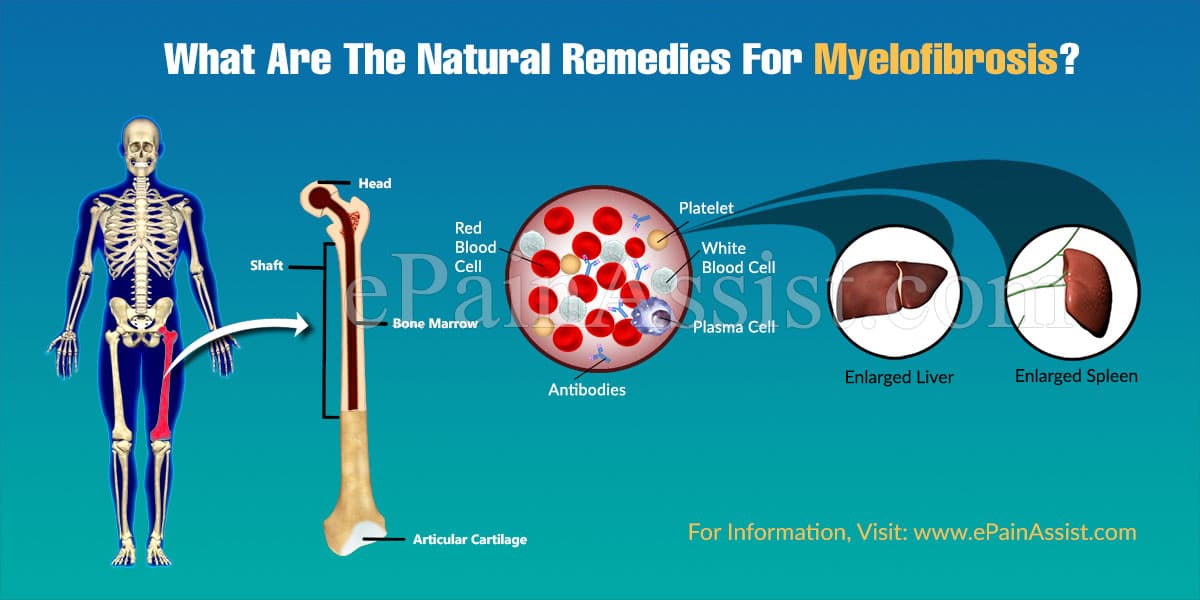 What Are The Natural Remedies For Myelofibrosis?