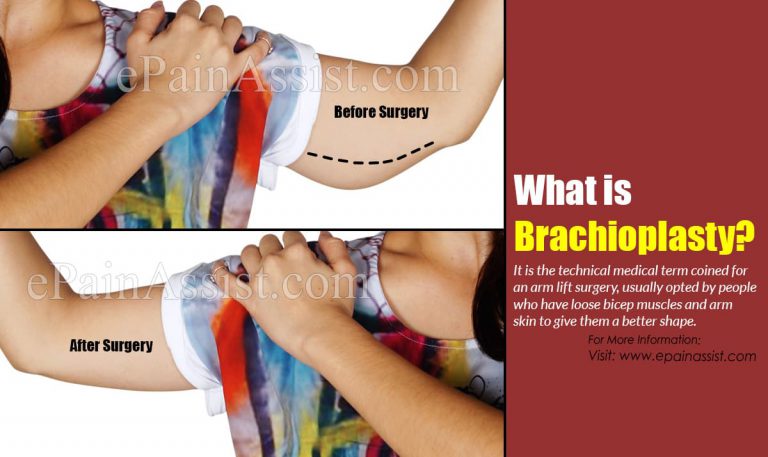 Brachioplasty: Indications, Techniques, Possible Complications