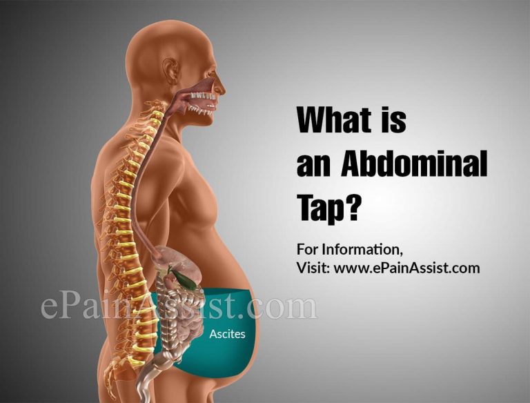 What is an Abdominal Tap: Procedures, Risks, Recovery, Outlook