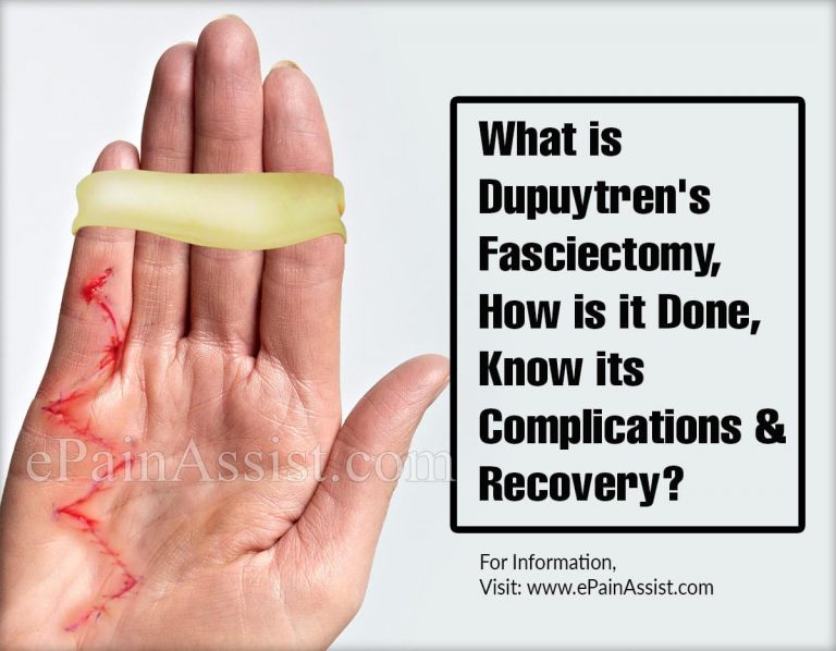 What is Dupuytren’s Fasciectomy, How is it Done, Know its Complications and Recovery?