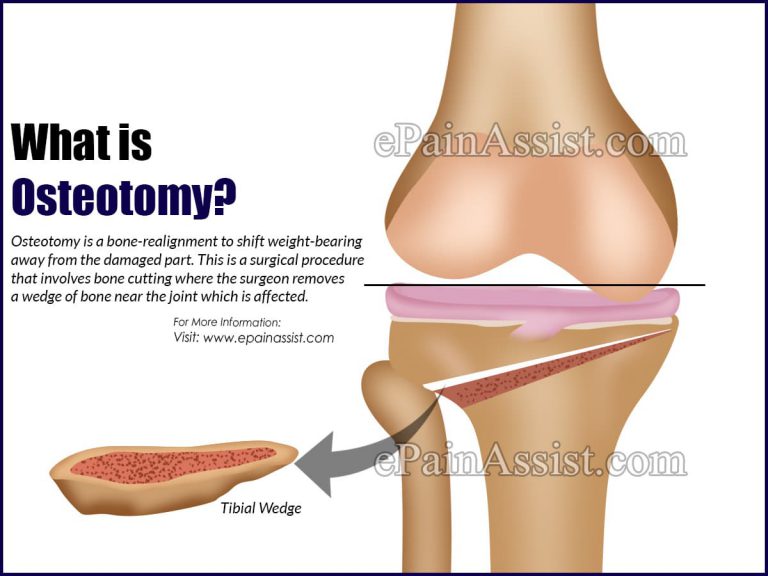 Osteotomy:  Who is a Good Candidate for Osteotomy & On Which Bone or Joint is Osteotomy Performed?