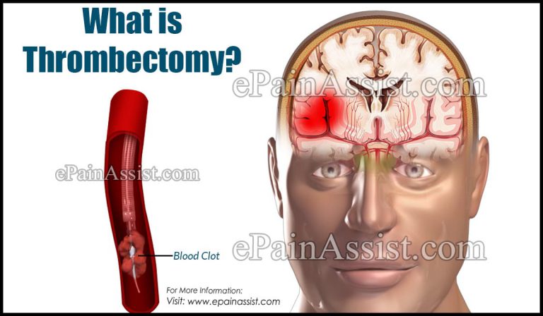 What is Thrombectomy & How is it Done?|Risks & Benefits of Thrombectomy
