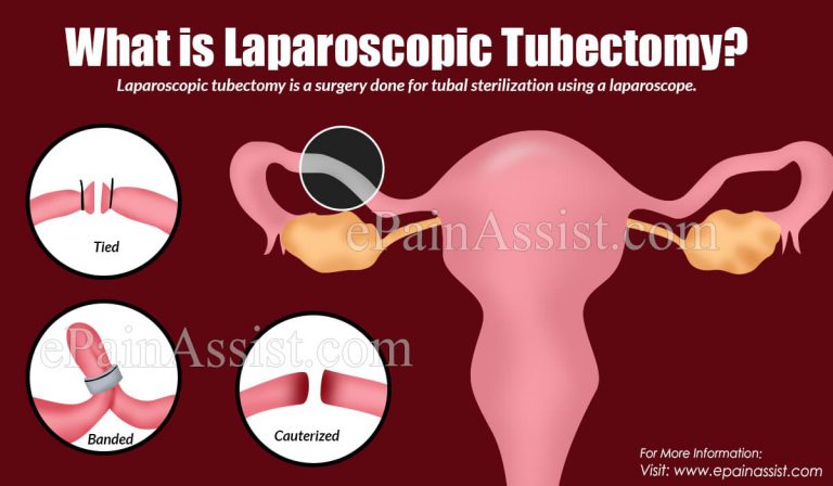 Laparoscopic Tubectomy: Indications, Procedure, Advantages, Disadvantages, Complications, Contraindications