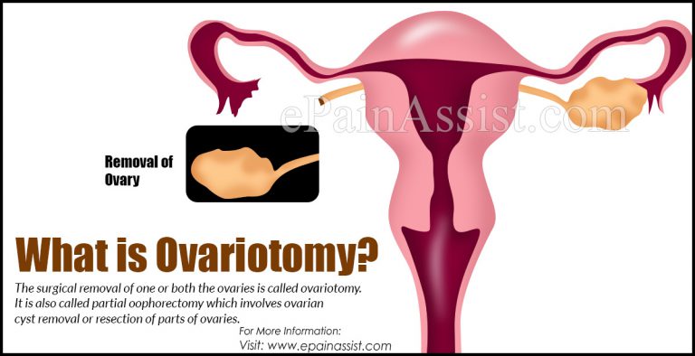 Ovariotomy: Indications, Procedure, Risks, Complications