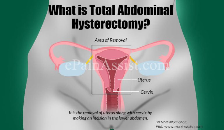 Total Abdominal Hysterectomy: Types, Indications, Procedures, Complications, Recovery