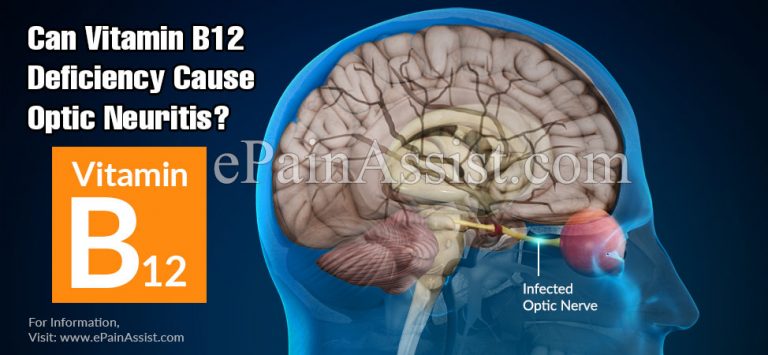 Can Vitamin B12 Deficiency Cause Optic Neuritis & Can You Go Blind From It?